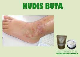 Justeru amatlah penting untuk mengikut segala arahan rawatan dan membersihkan bahan yang tercemar dengan penyakit tersebut. Soleehaa Anggun Beauty Tips Menghilangkan Kudis Buta Dengan Cepat