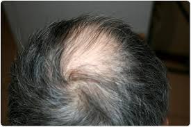 This is among the most common causes of hair loss. Medications That Can Cause Alopecia Hair Loss Healthtopical