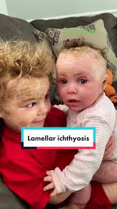 Image result for Ichthyosis