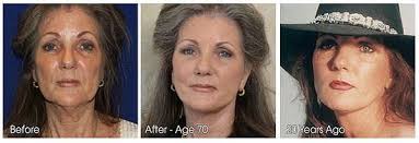 La clinique hannibal a réuni les meilleurs praticiens tunisiens pour garantir une intervention de lifting visage sûre et efficace. Before And After Pictures Of A Woman Who Has Had A Facelift Surgery Face Lift Surgery Cosmetic Medicine Plastic Surgery