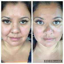 Chest area before and after results