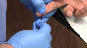Image result for Capillary Puncture