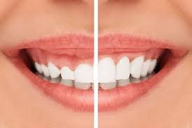 Can botox fix a gummy smile? Gummy Smile Gummy Smile Treatment Newsmile Dental Perth