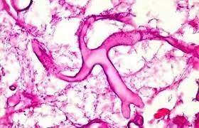 A maioria dos sintomas frequentemente resulta de lesões necróticas invasivas no nariz e no palato, acompanhadas de dor, febre, celulite orbitária, proptose e secreção nasal purulenta. Tres Casos Suspeitos De Mucormicose O Fungo Negro Sao Investigados Em Sc Nsc Total
