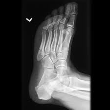 Metatarsal bones are the long bones in the middle of your foot that connect your heel and arch to your toes. Jones Fracture Radiology Reference Article Radiopaedia Org