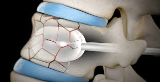 Image result for Kyphocarpa