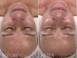 The new skin that replaces it is usually smoother and less wrinkled in appearance. Why Winter Is The Best Time For A Chemical Peel Askcares