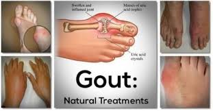 1 Cara Mengobati Bengkak Akibat Asam Urat Obat Asam Urat Alami Asam Urat Kesehatan Tips