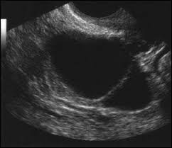An ovarian cancer ultrasound is one of several diagnostic tests that your doctor will use to determine if ovarian cancer is present. Some Ovarian Tumors Can Be Safely Followed On Ultrasound