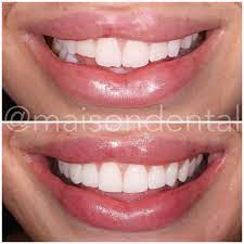 Maison Dental On Instagram One From The London Clinic This Case Was A Combination Of Composite Edge Bonding On Th Composite Veneers Dental Teeth