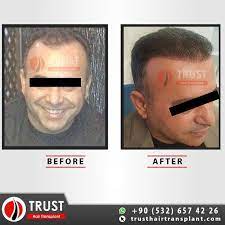 Haartransplantation In Der Turkei Hair Transplant Der Haartransplantation Hair Tr Hair Transplant Hair Loss Remedies Hair Transplant Before And After