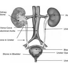 Pdf Review On Uro Lithiasis Pathophysiology And Aesculapian Discussion