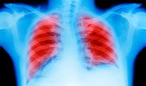 When lung cancer symptoms are present, they are different in each person, but may include these. Lung Cancer Symptoms Three Less Common Signs And Treatment Available Express Co Uk