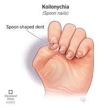 Image result for Koilonychia feet