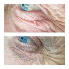 Check spelling or type a new query. Skin Tag Oasis Wellbeing Clinic