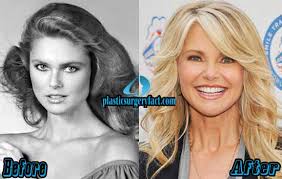 Unfortunately, accidents, age or genes can lead to a loss of full or partial vision, leaving us with a foggy or blurred vie. Christie Brinkley Plastic Surgery Before And After Photos Plastic Surgery Facts
