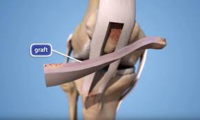 Find the perfect leg ligaments stock illustrations from getty images. Anterior Cruciate Ligament Acl Injuries Orthoinfo Aaos
