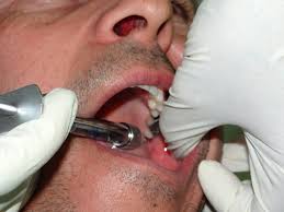 Overview Of Local Anesthesia Techniques Intechopen