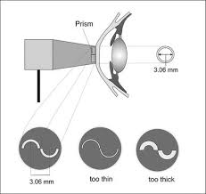 Conventional Intraocular Pressure Measurement Techniques