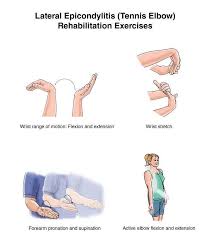 Onset of symptoms is generally gradual. Physioosteobook Tennis Elbow Rehab Exercises Facebook