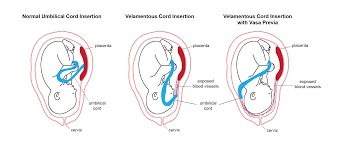 Perinatal outcomes associated with isolated velamentous cord insertion in singleton and twin pregnancies journal of ultrasound medicine. Velamentous Cord Insertion Wikipedia