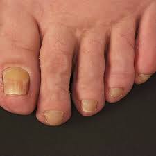Image result for Yellow nail syndrome feet