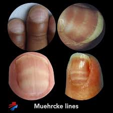 Image result for Muehrcke Line