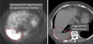 Information for patients having their scan at lister hospital, stevenage. Pet Ct Imaging For Target Volume Delineation In Curative Intent Radiotherapy Of Non Small Cell Lung Cancer Iaea Consensus Report 2014 Radiotherapy And Oncology