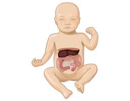 Image result for Intestinal Atresia