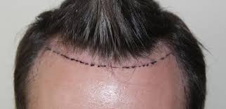 Dr Keser 1600 Grafts Ankara Turkey Hair Transplant Uk Hair Transplant Hair Transplant Results