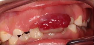 Image result for granuloma gum disease
