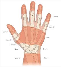 Tendon lacerations within the digital sheath are difficult to repair. 26 Tendon Repair Plastic Surgery Key