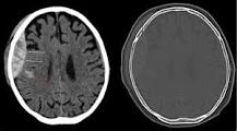 Image result for icd 10 code for intracranial bleed