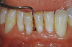 Is Periodontal Disease Contagious Westermeier Martin