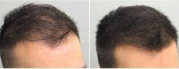 Scalp hair loss is often a major concern for transgender women and transfeminine people. Blog Super Billion Hair Disfarce Para Calvicie Cura Para Queda De Cabelo Oleo Para Crescimento Do Cabelo Produtos Para Queda De Cabelo