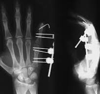 External Fixation System | Acumed