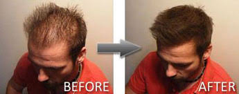 For men with thin or fine hair, try keeping the top fairly short with shorter back and sides. Hair Thickening Spray For Men