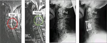 Prof Dr Christian Woiciechowsky Neurochirurgie Berlin Wirbelkanalverengung An Der Hws