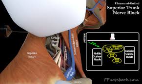 Image result for Superior Trunk Block