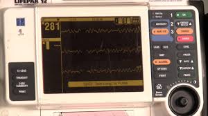 P < 0,001] and ap correct defibrillator pad choices and placement have improved knowledge and can retain that. Defibrillator Usage And Paddle Placement Youtube