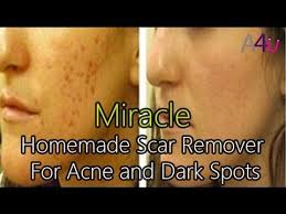 Miracle Homemade Scar Remover For Acne And Dark Spots Acne Home Remedies For Acne Acne Remedies