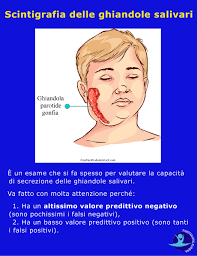 La sindrome di sjögren è una malattia autoimmune sistemica coinvolgente le ghiandole esocrine, caratterizzata da un infiltrato linfoplasmocellulare che conduce alla la prevalenza della sindrome di sjögren nella popolazione generale non è stata ancora precisamente valutata: Sindrome Di Sjogren E Dolori Muscolari Sintomi E Terapia