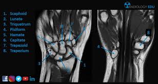The other four, superior or brachial, inferior or metacarpal , external or. Radiology Edu No Twitter Mri Anatomy Of The Carpal Bones Radiologyedu Myradiologyedu Radiologyeducation Myradiologyeducation Radiology Myradiology Medicine Anatomy Msk Carpalbones Medical Imaging Mri Radiographer Radtech