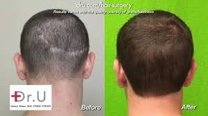 I thank you for this information. How Much Money Does A Hair Transplant Cost Quora