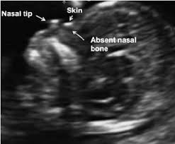 A Midsagittal Section Of A 12 Week Fetus Demonstrating An Absent Nasal Download Scientific Diagram