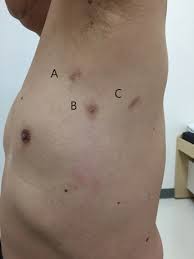 Video Assisted Thoracoscopic Surgery For Intrathoracic First Rib Resection In Thoracic Outlet Syndrome Hwang Journal Of Thoracic Disease