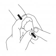 Image result for paraphimosis