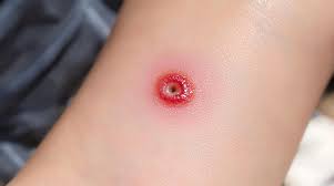 Image result for wolf spider bite skin