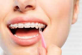 After the orthodontist removes your braces, you may be left with the residue of the dental glue that held them in place 1 2. How To Put Rubber Bands On Braces Premier Orthodontics
