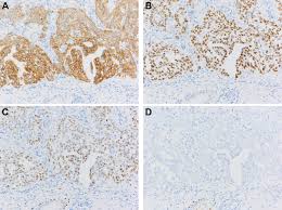 Nicotine and other chemicals in cigarettes and cigars can cause lung damage. Best Practices Recommendations For Diagnostic Immunohistochemistry In Lung Cancer Journal Of Thoracic Oncology